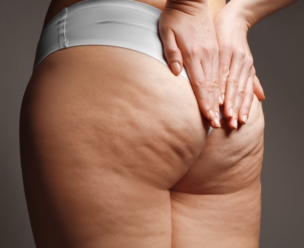 Photo of cellulite on a woman's buttocks