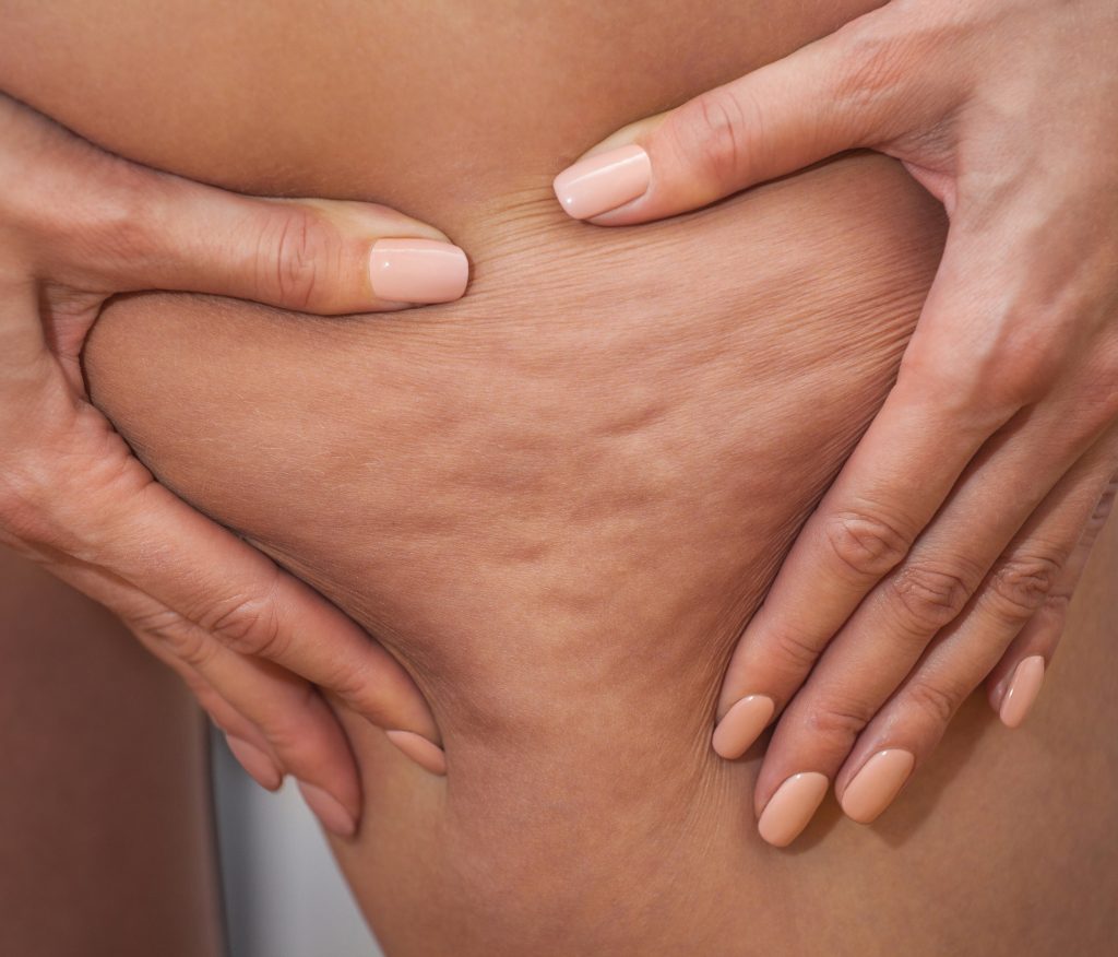 Photo of cellulite on a woman's leg