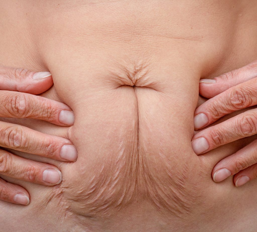 Photo of loose skin on a woman's stomach