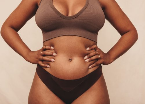 Photo of a woman's body after CoolSculpting® body sculpting treatments