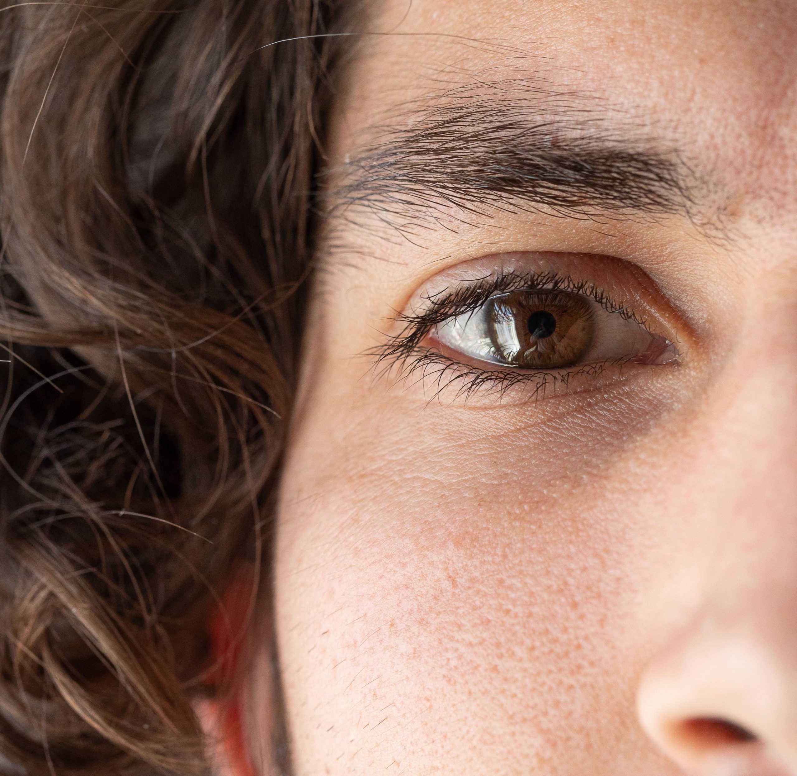 Photo of a man's eye and eyelid months after eyelid surgery