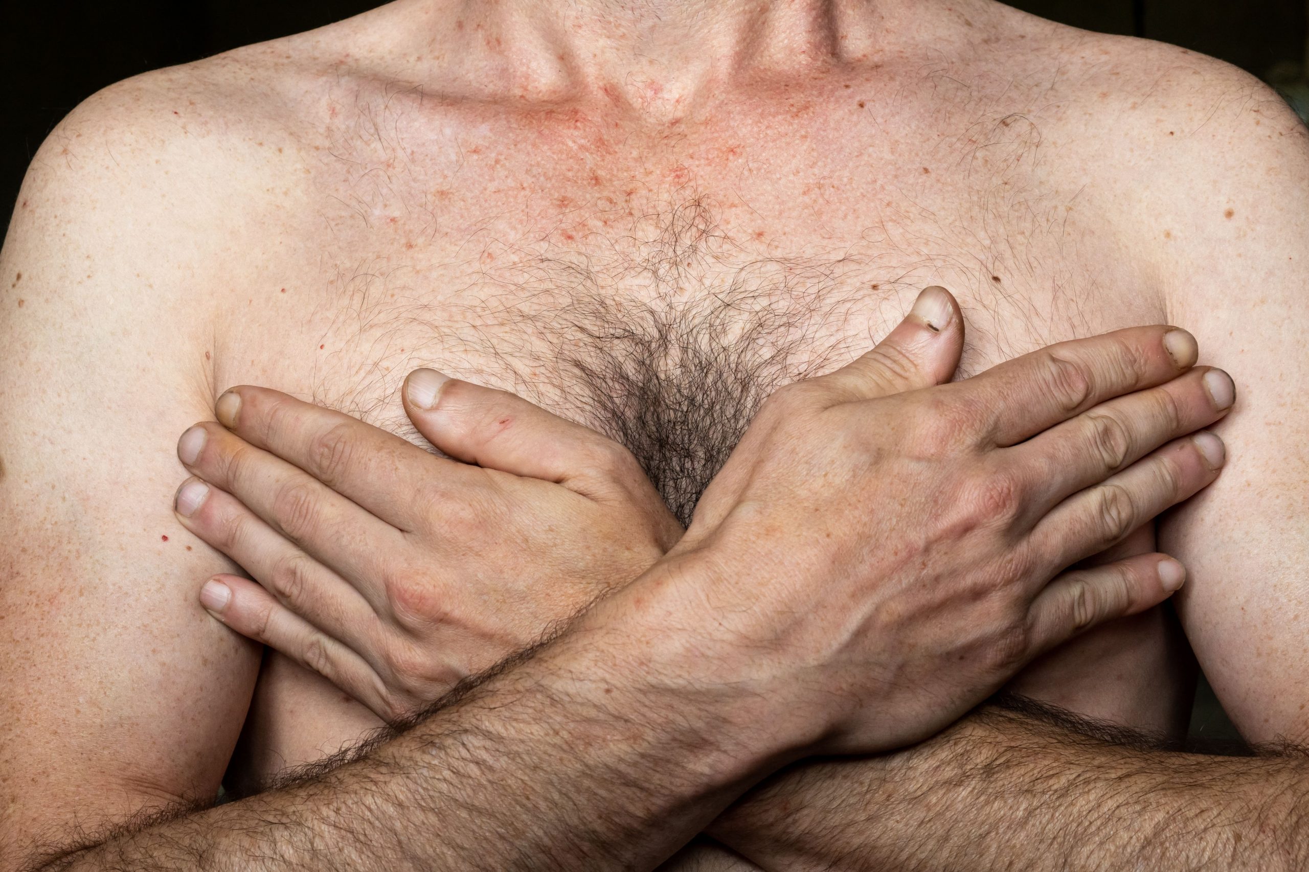Gynecomastia