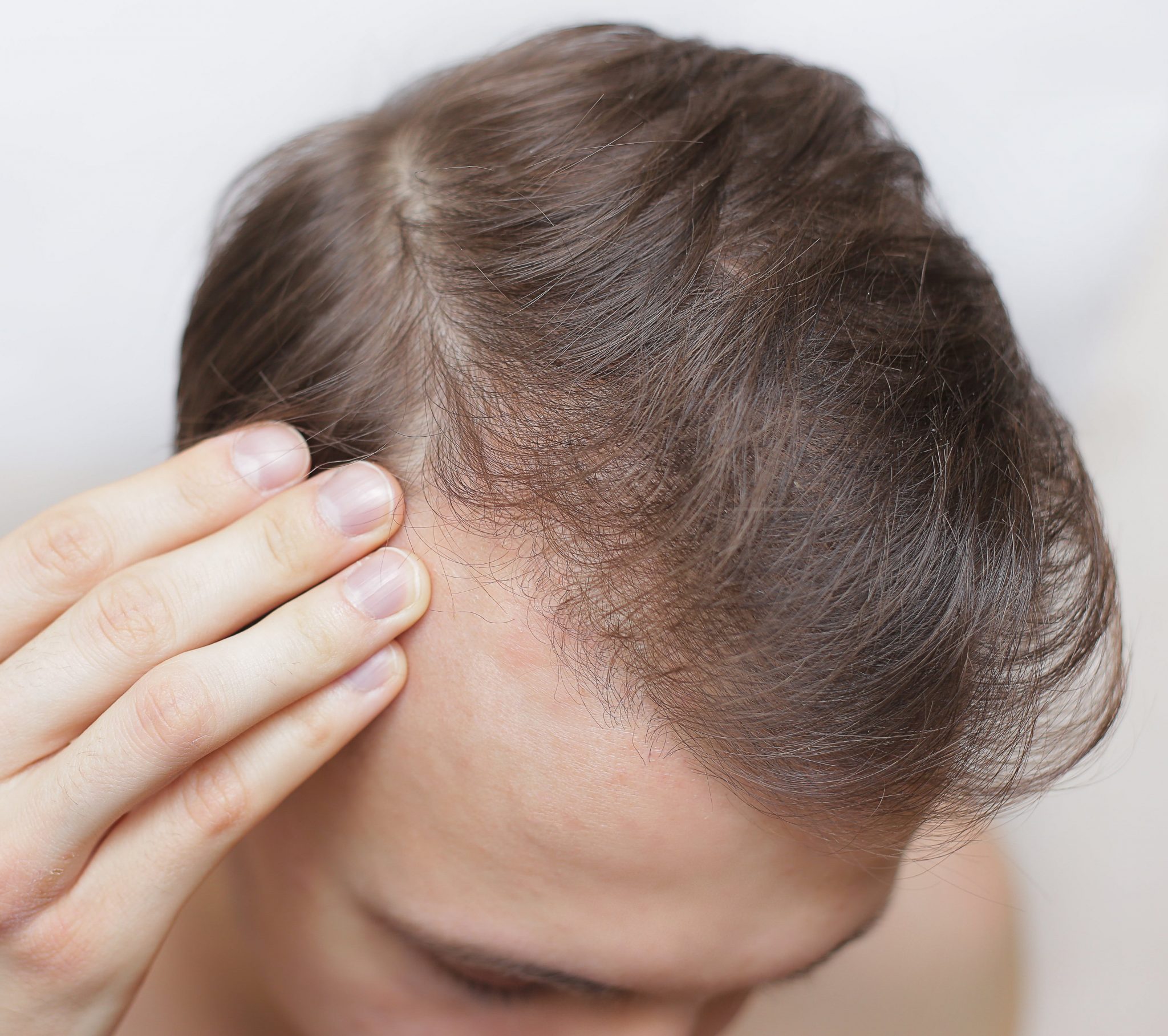 Photo of a man experiencing hair loss and a thinning hairline