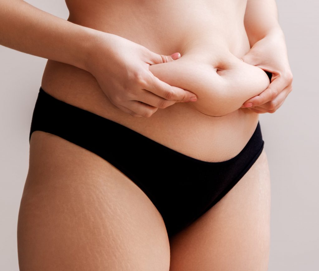 Photo of a woman pinching the fat and loose skin in her abdomen area.