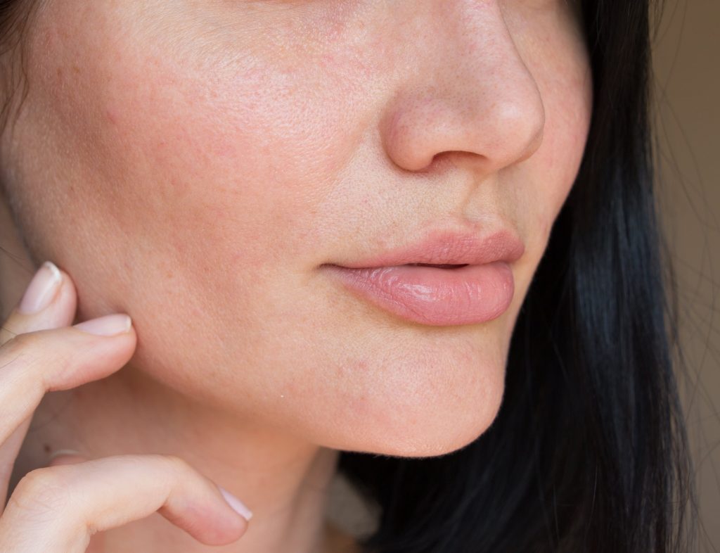 Photo of a woman with slight facial redness on her face