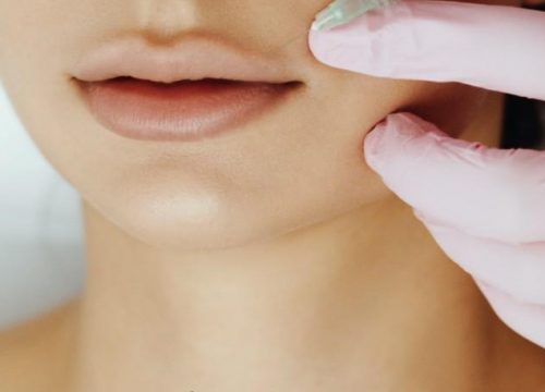 Photo of a woman getting a lip lift