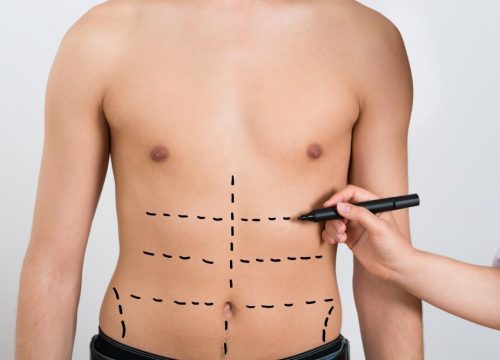 Photo of a man getting prepped for a liposuction procedure