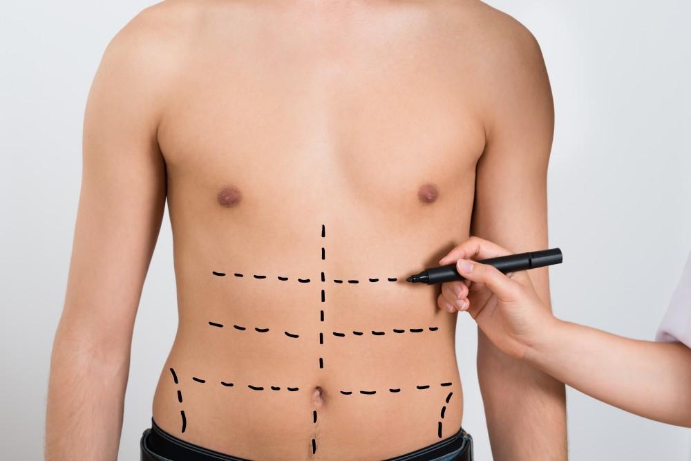 Why Choose High-Definition Liposuction over Regular Liposuction