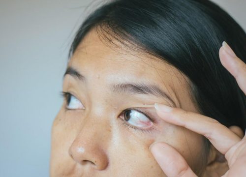 Photo of a woman touching her eyelids to hold them open wider