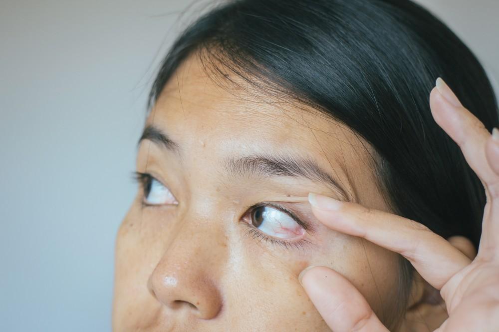 The Extra Skin on My Eyelids is Affecting My Sight: Can You Help?