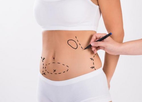 Photo of a woman being prepped for liposuction