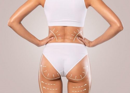 Photo of a woman being prepped for a Brazilian Butt Lift