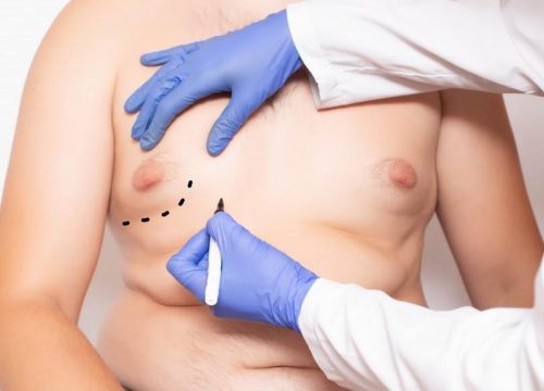 Photo of a man getting prepped for gynecomastia surgery