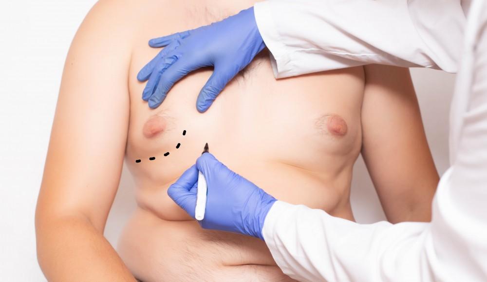 Correcting Gynecomastia: Liposuction, Male Breast Reduction, or Both?