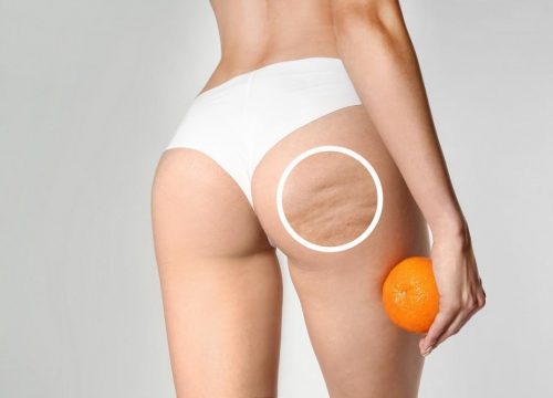 Photo of cellulite on a woman's buttocks