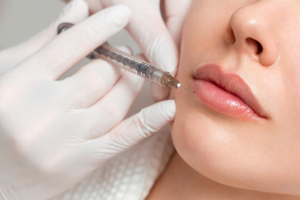 Lip Lift vs. Lips Fillers: Which One is Right For You?