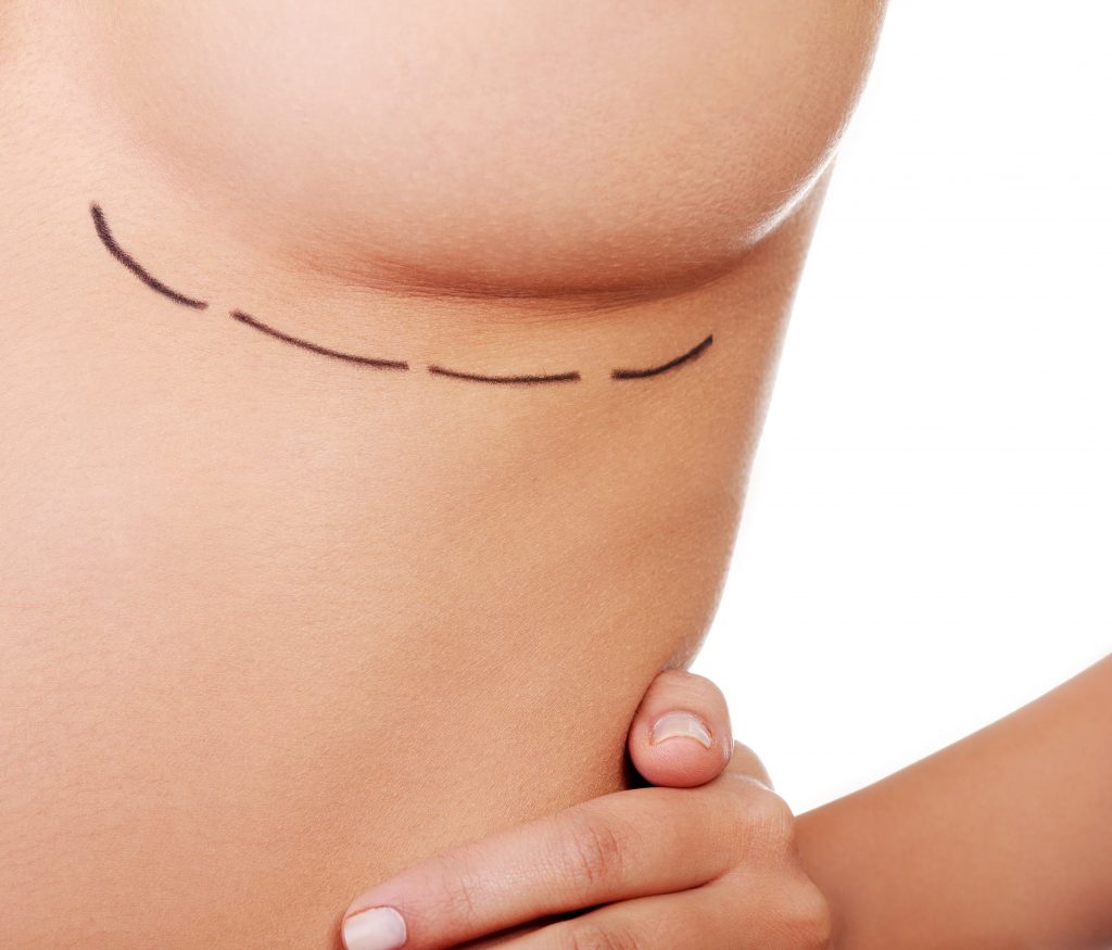 Photo of a patient being prepped for chest masculinization surgery