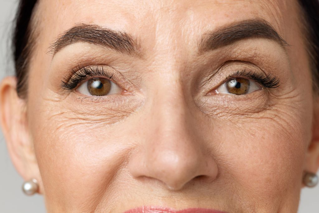 Photo of under-eye wrinkles on a middle-aged woman's face